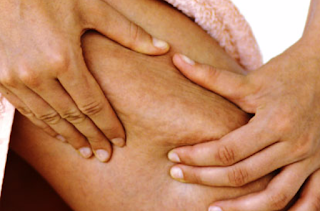 cellulite,-causes,-cures-and-prevention.